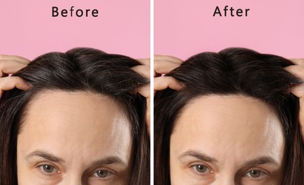 Image of Woman suffering from baldness on pink background, closeup. Collage with photos before and after treatment