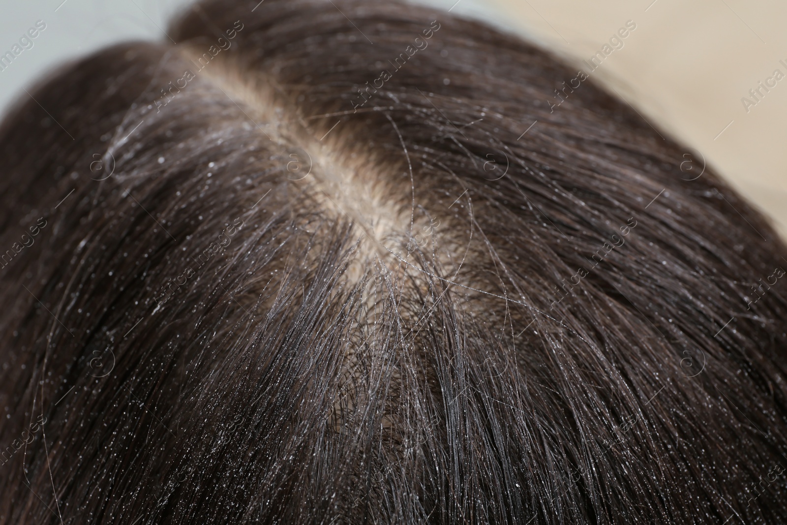 Photo of Woman with dandruff in her dark hair, closeup view