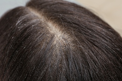 Photo of Woman with dandruff in her dark hair, closeup view