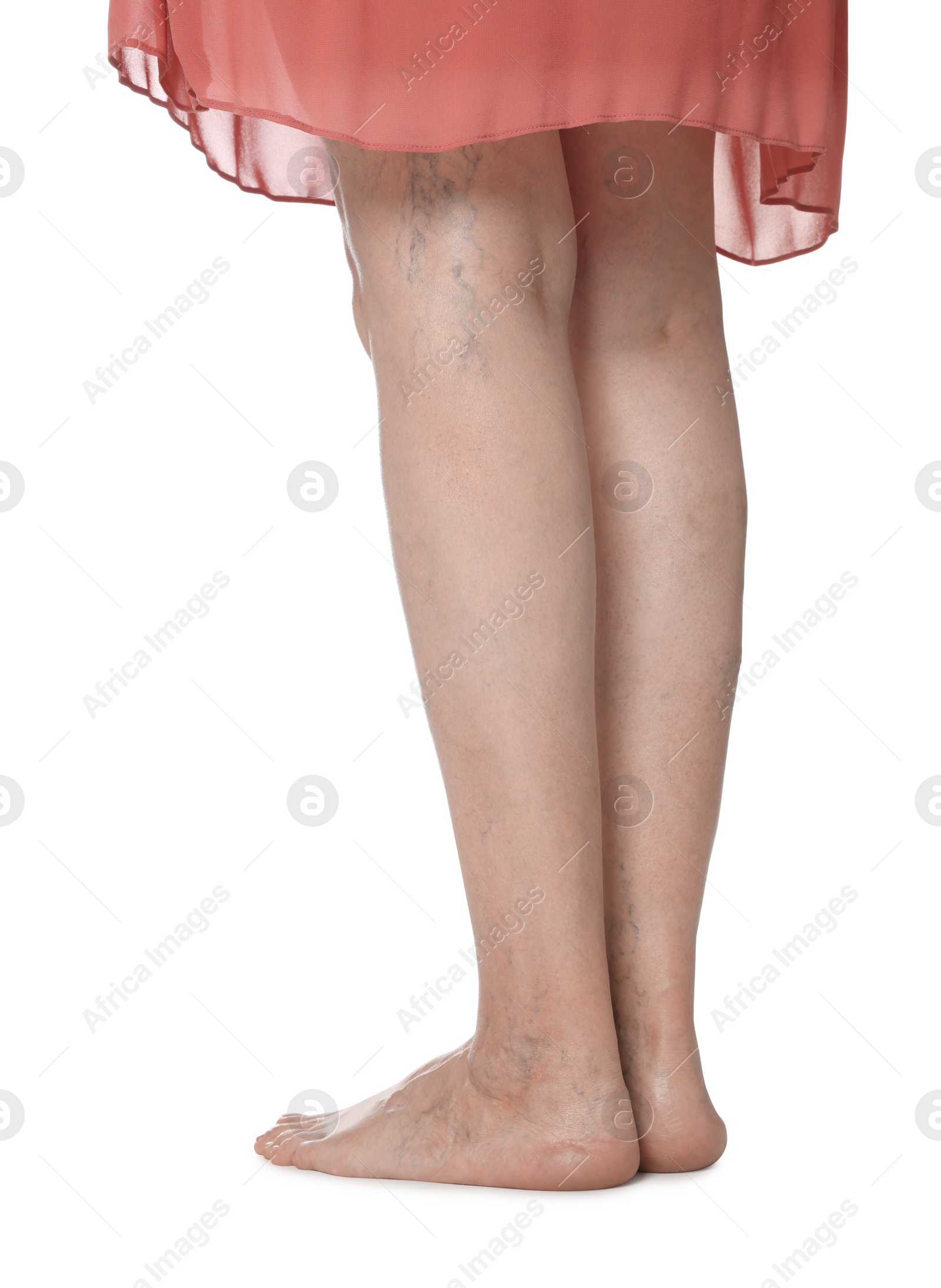 Photo of Closeup view of woman with varicose veins on white background