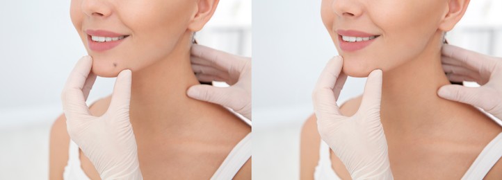 Collage with photos of patient's face before and after mole removing procedure, closeup. Dermatologist checking woman's skin