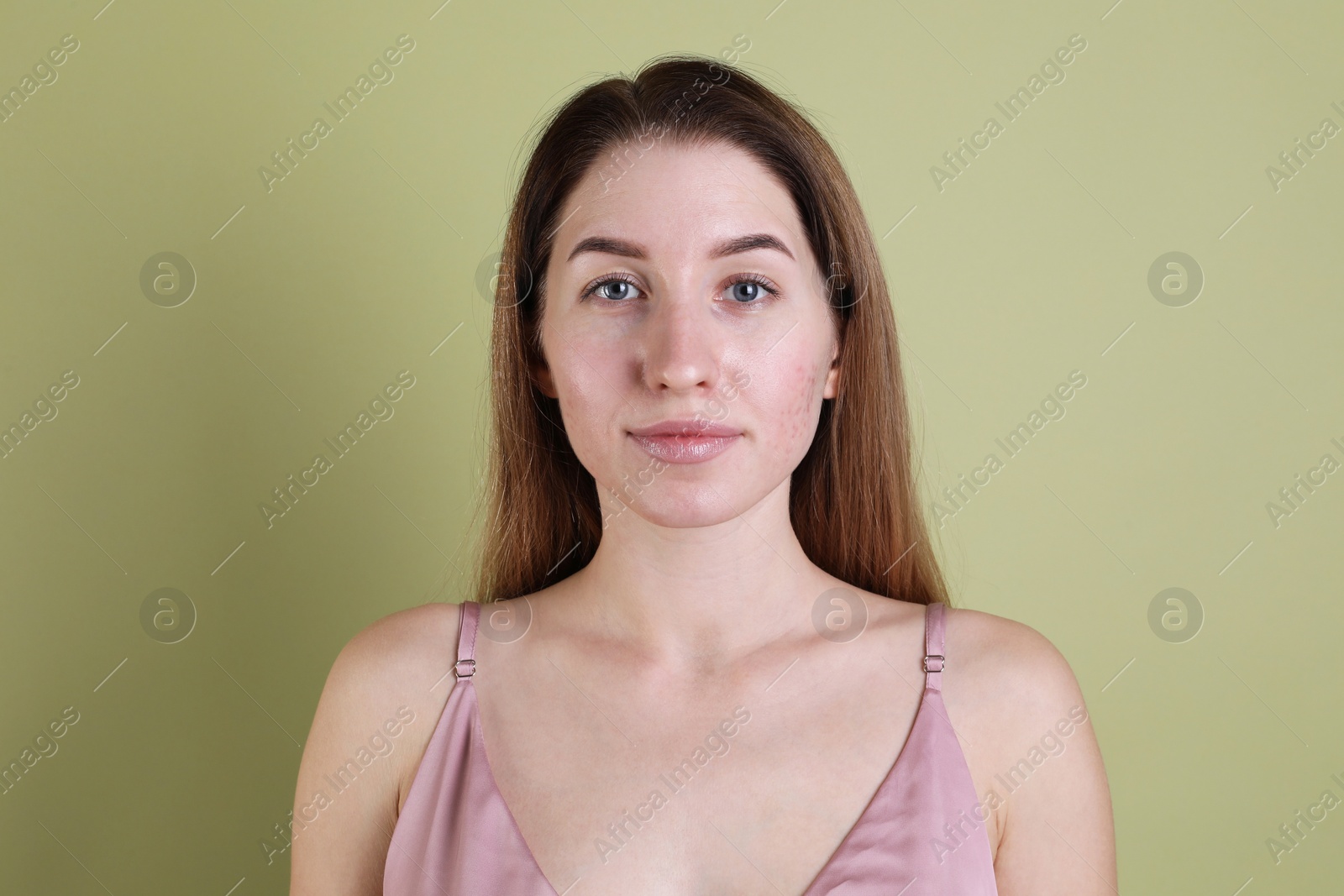 Photo of Young woman with acne problem on olive background