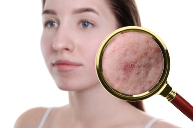 Image of Dermatology. Woman with skin problem on white background. View through magnifying glass on acne