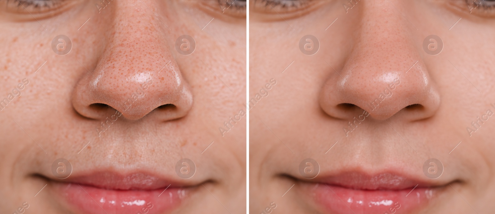 Image of Blackhead treatment, before and after. Collage with photos of woman, closeup view