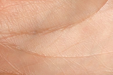 Photo of Closeup view of human hand with dry skin