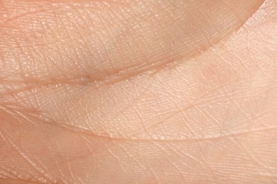 Closeup view of human hand with dry skin