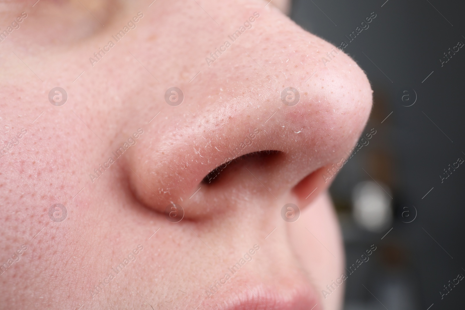 Photo of Woman with dry skin on nose, closeup