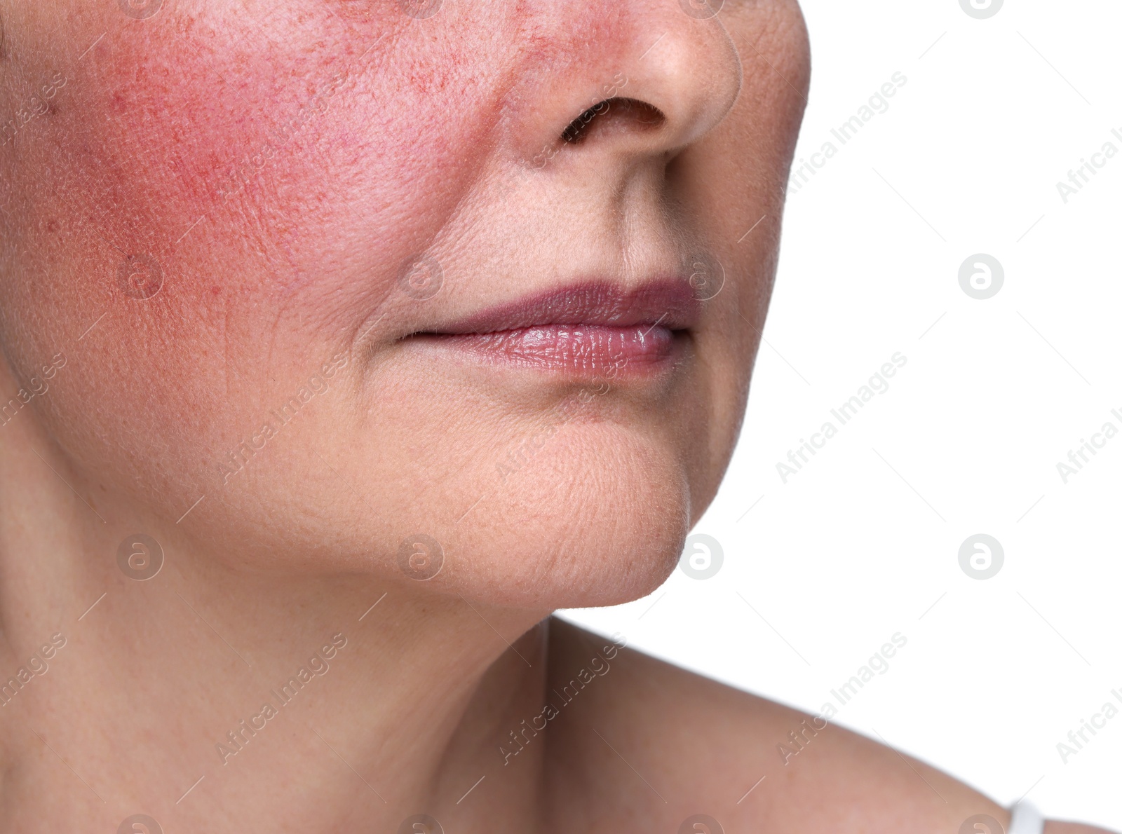 Image of Woman with rosacea on white background, closeup. Problem skin treatment