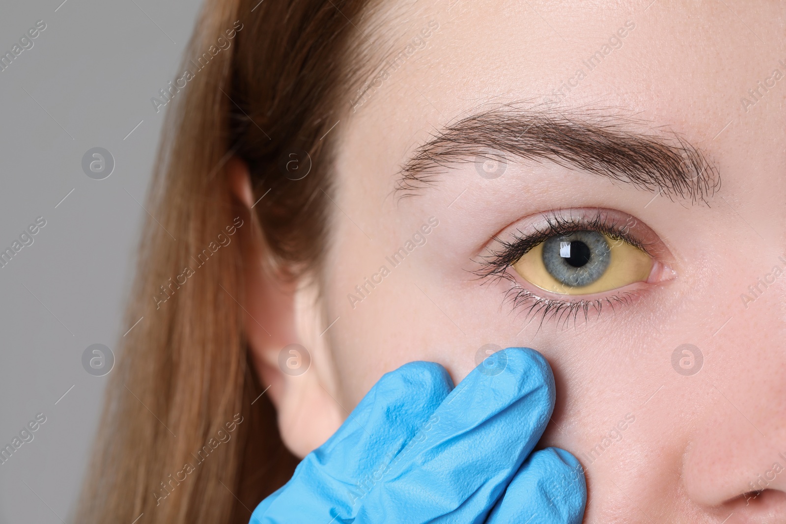 Photo of Doctor checking woman with yellow eyes on light background, closeup. Symptom of hepatitis