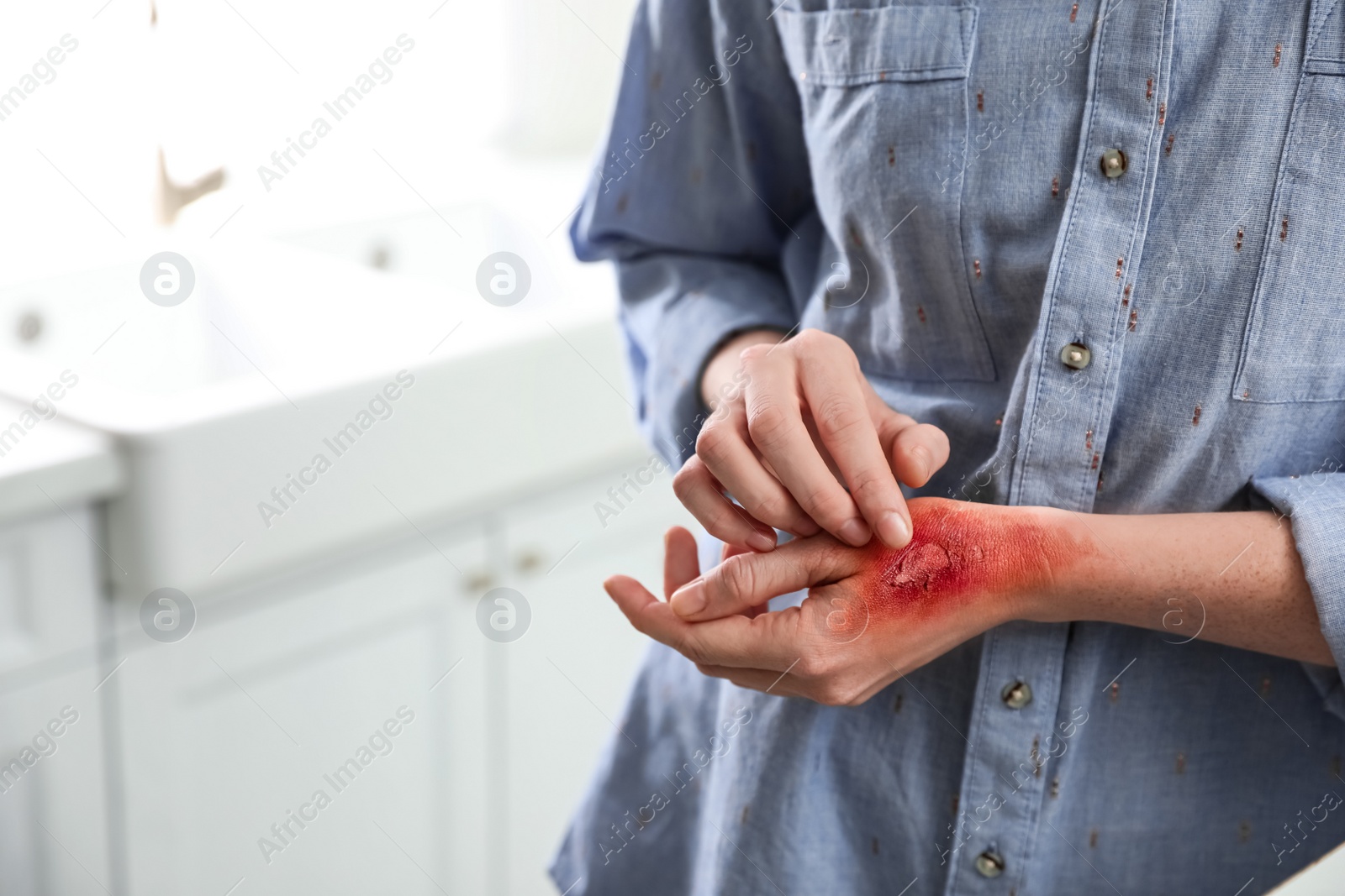 Photo of Woman with burn on her hand indoors, closeup. Space for text