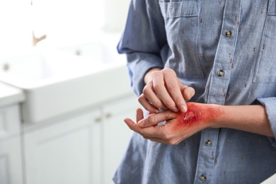 Photo of Woman with burn on her hand indoors, closeup. Space for text