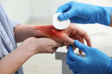 Doctor covering patient's burn of hand with cotton pad indoors, closeup