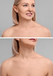Image of Collage with photos of woman before and after cosmetic procedure on grey background