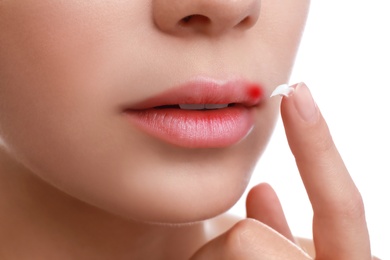 Young woman with cold sore applying cream onto lips against white background, closeup