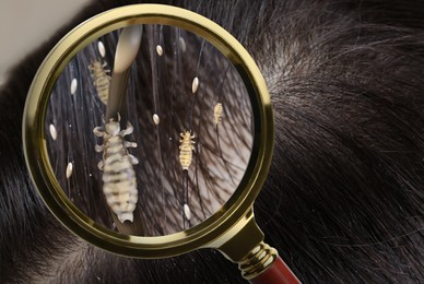 Image of Pediculosis. Woman with lice and nits, closeup. View through magnifying glass on hair