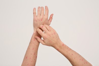 Photo of Man with rash suffering from monkeypox virus on beige background, closeup
