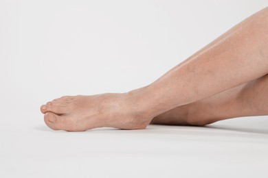 Closeup view of woman with varicose veins on light background