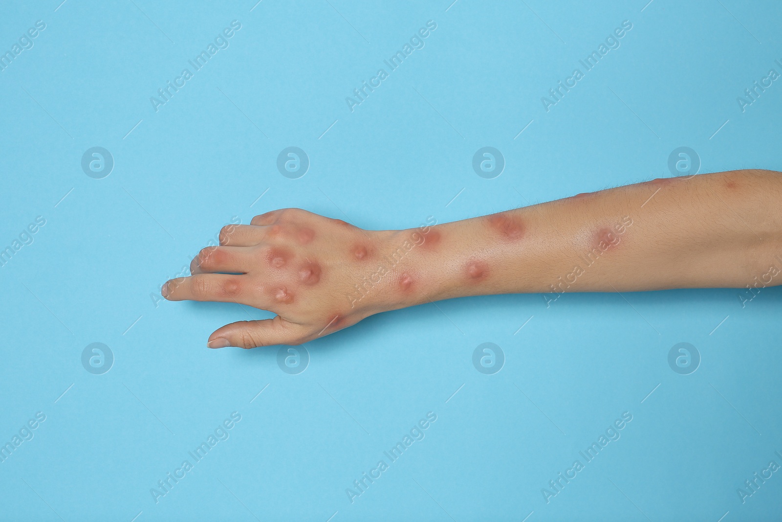 Photo of Woman with rash suffering from monkeypox virus on light blue background, closeup