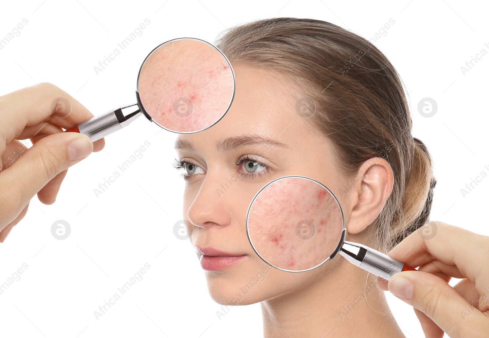 Image of Young woman with acne problem visiting dermatologist, closeup. Skin under magnifying glass