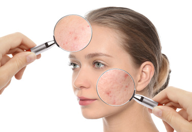 Young woman with acne problem visiting dermatologist, closeup. Skin under magnifying glass