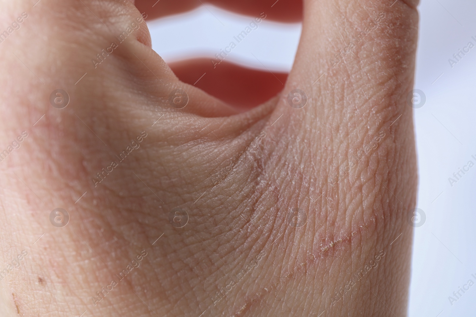 Photo of Woman with dry skin on hand against light background, closeup