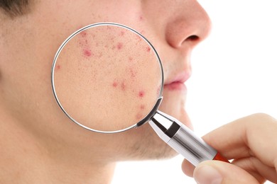 Image of Dermatologist looking at man's face with magnifying glass on white background, closeup. Zoomed view on acne