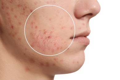 Dermatology. Man with skin problem on white background, closeup. Acne on face