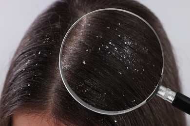 Image of Woman suffering from dandruff on light background, closeup. View through magnifying glass on hair with flakes