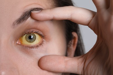 Photo of Woman with yellow eyes on light background, closeup. Symptom of hepatitis