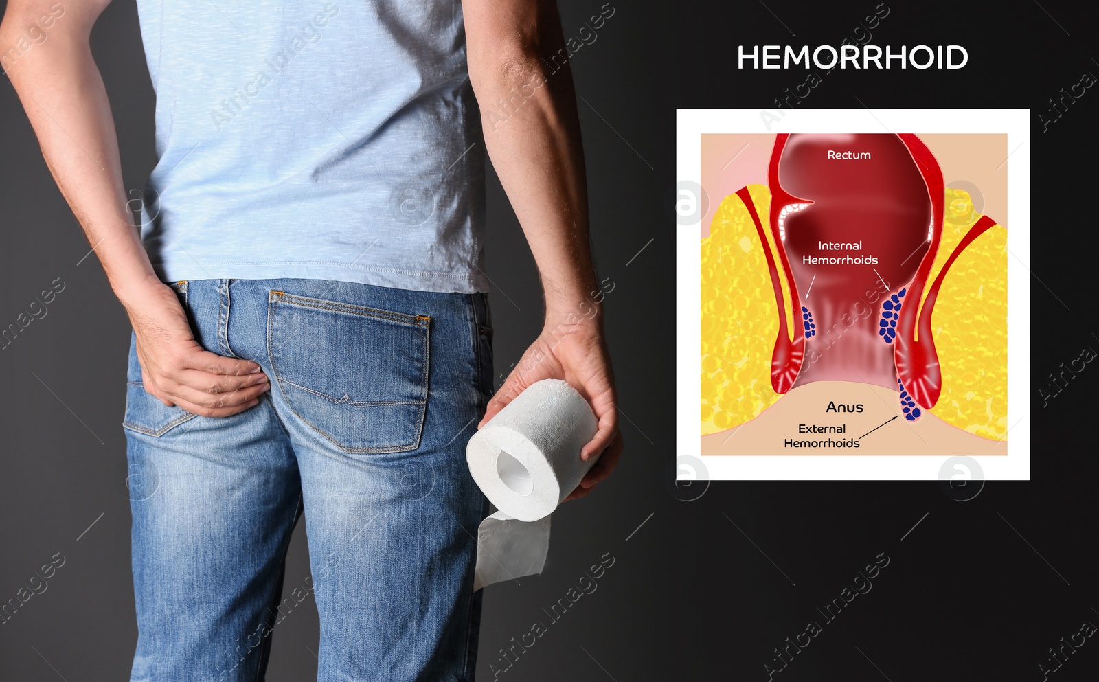 Image of Man with toilet paper suffering from hemorrhoid pain on black background, closeup. Illustration of unhealthy lower rectum