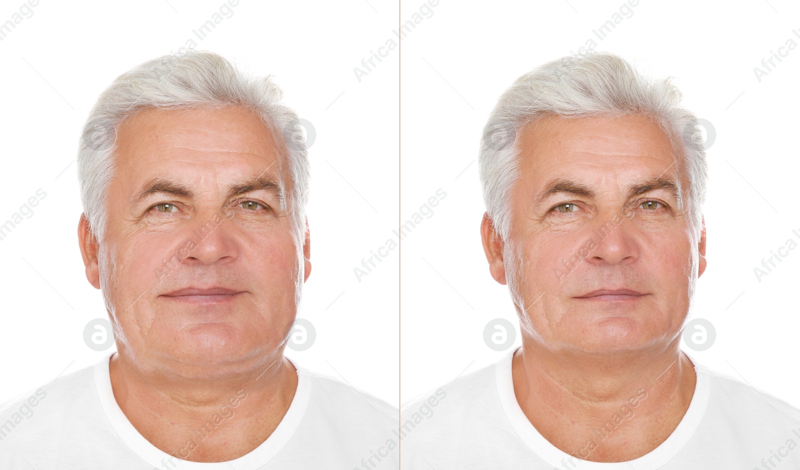 Image of Double chin problem. Collage with photos of senior man before and after plastic surgery procedure on white background