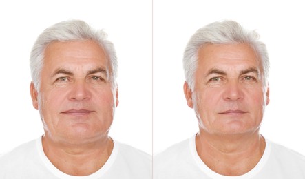 Image of Double chin problem. Collage with photos of senior man before and after plastic surgery procedure on white background