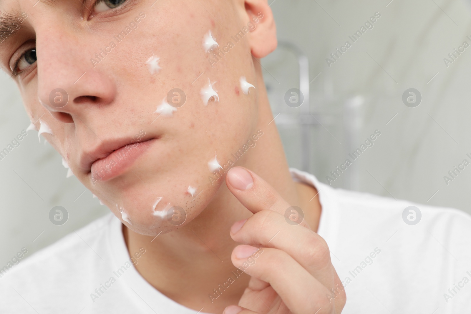 Photo of Teen guy with acne problem applying cream indoors, closeup