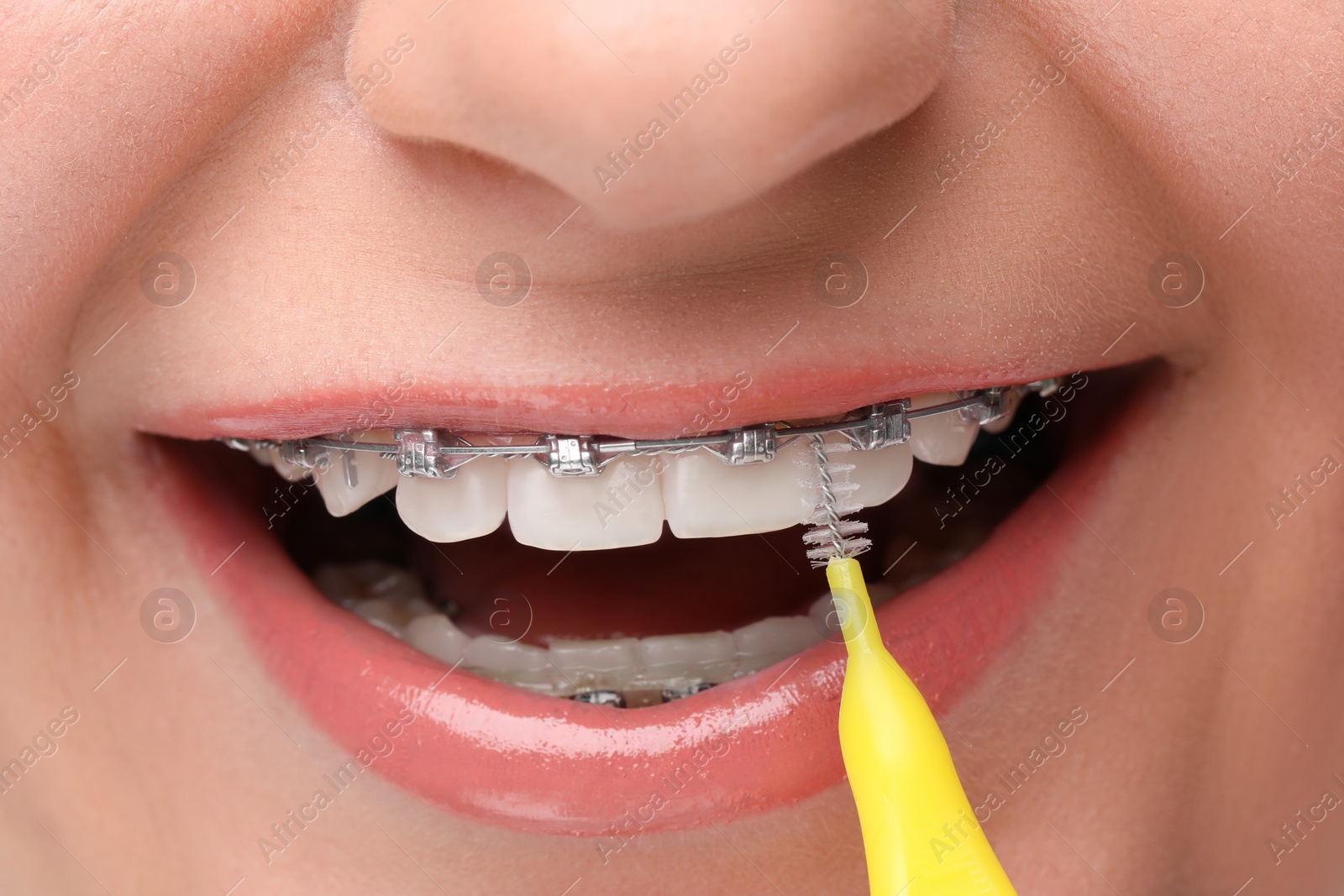 Photo of Woman with dental braces cleaning teeth using interdental brush, closeup