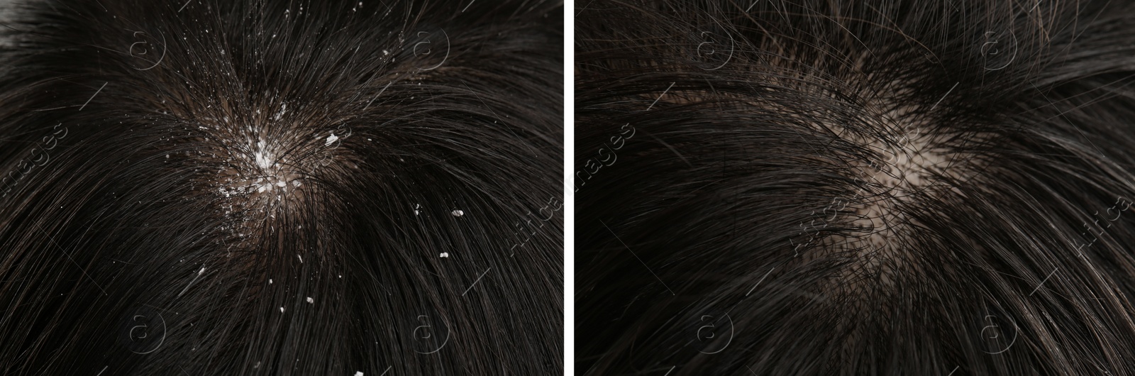 Image of Woman showing hair before and after dandruff treatment, collage