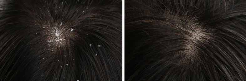 Image of Woman showing hair before and after dandruff treatment, collage