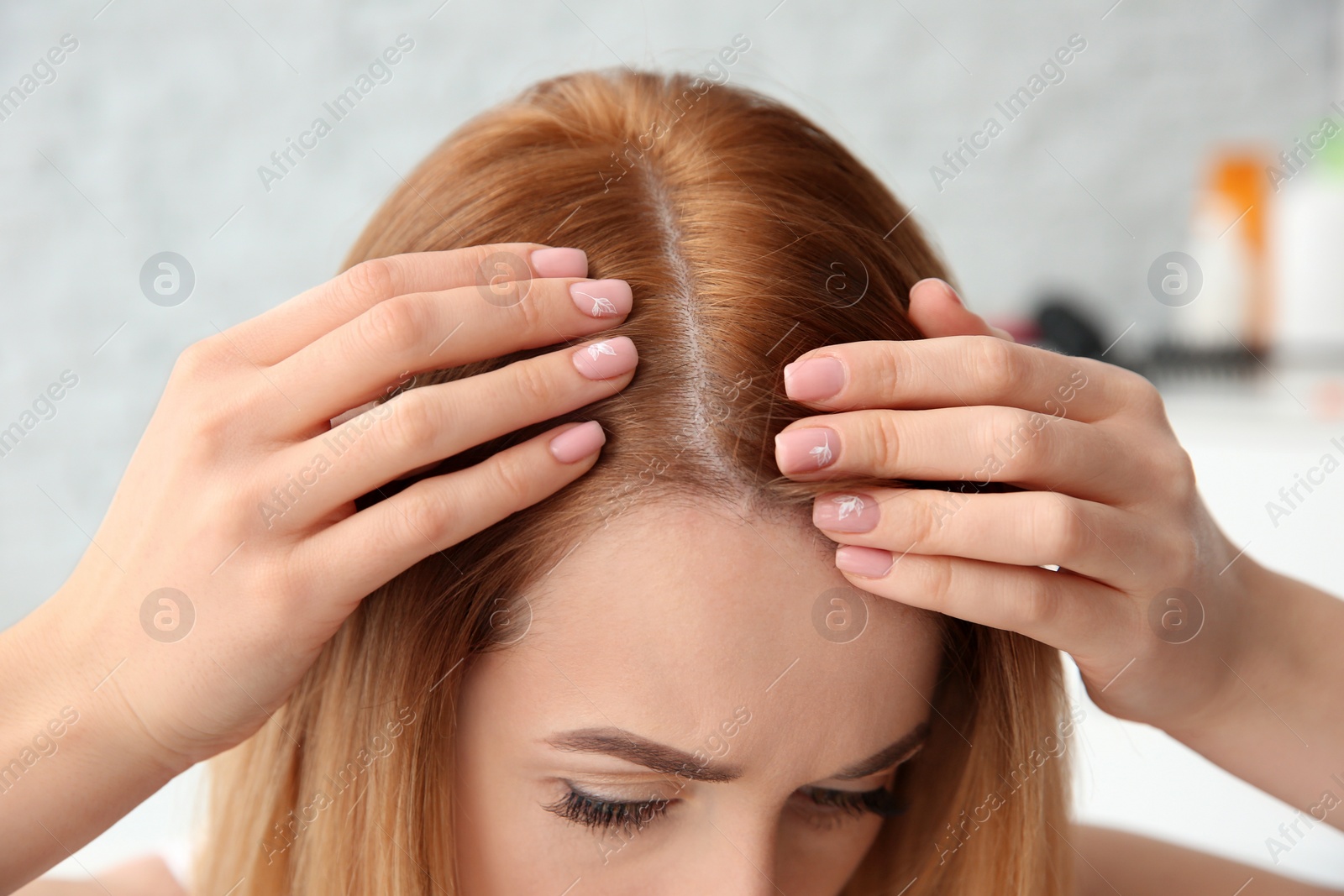 Photo of Young woman with hair loss problem, closeup