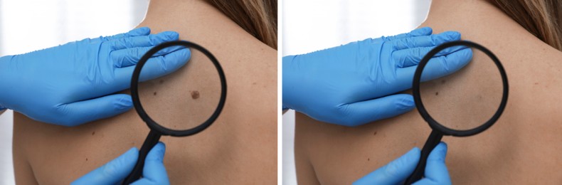 Mole removal. Collage with photos of patient's back before and after procedure, closeup. Dermatologist looking at skin through magnifying glass