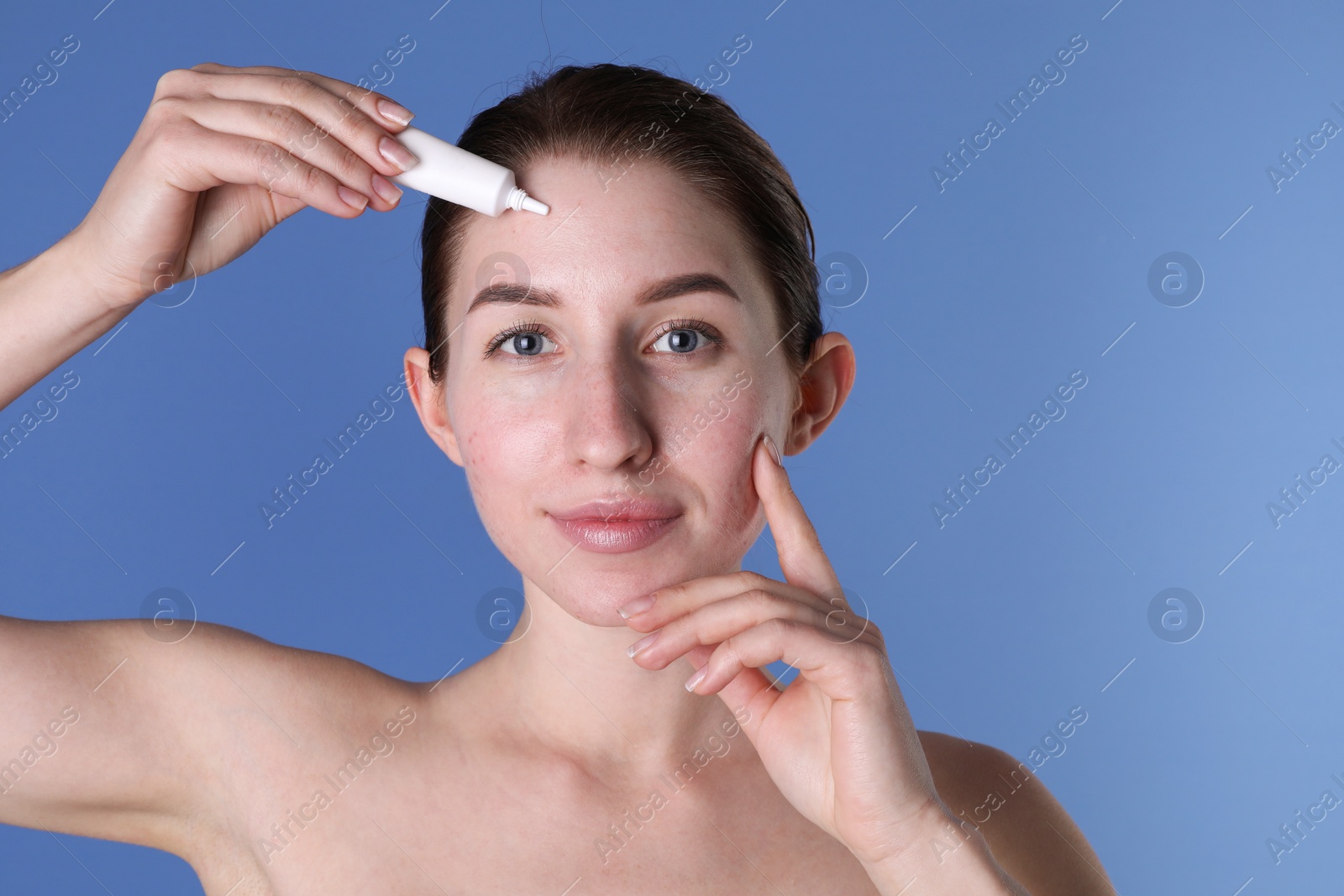 Photo of Young woman with acne problem applying cosmetic product onto her skin on blue background