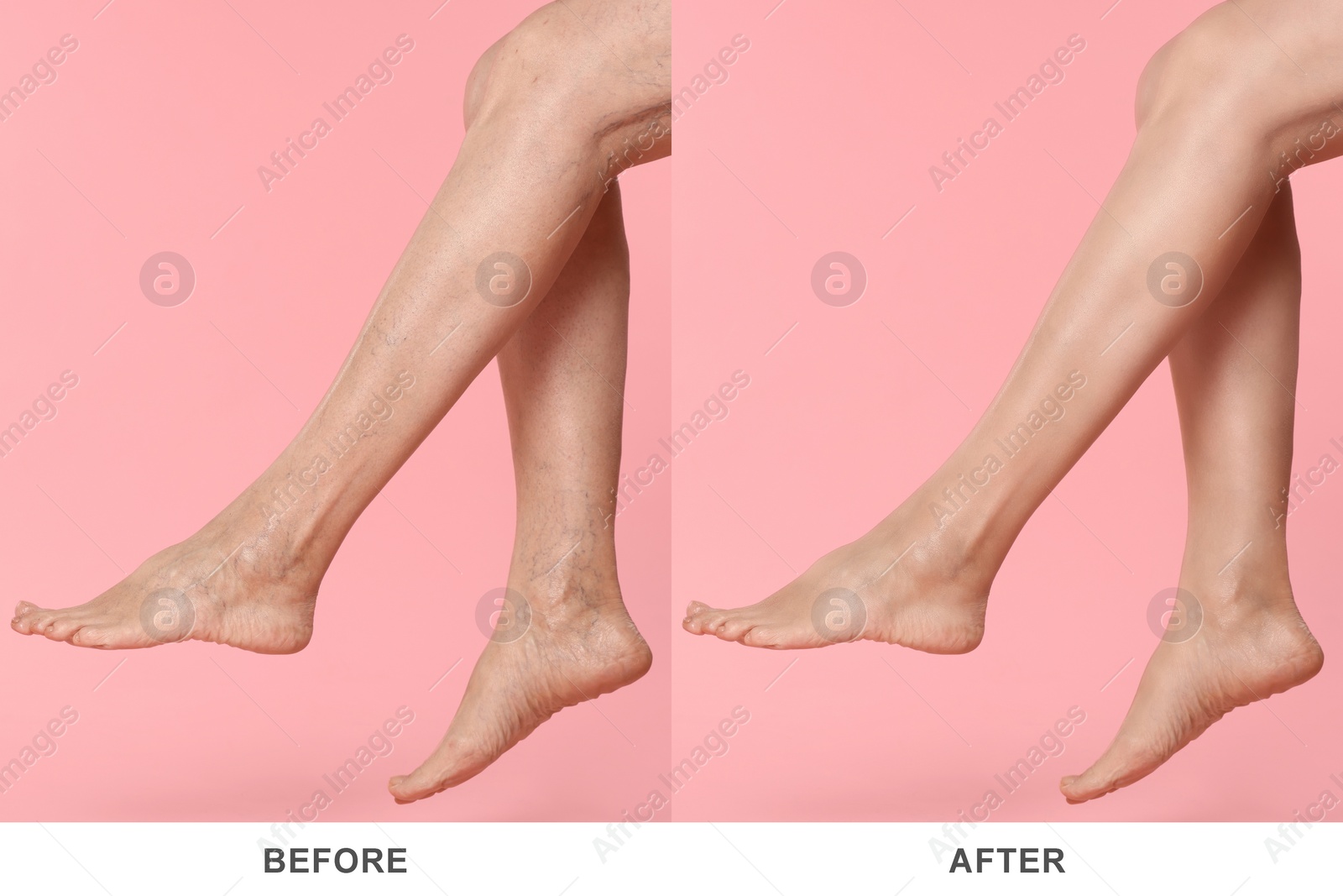 Image of Before and after varicose veins treatment. Collage with photos of woman showing legs on pink background, closeup