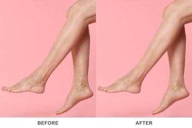 Before and after varicose veins treatment. Collage with photos of woman showing legs on pink background, closeup