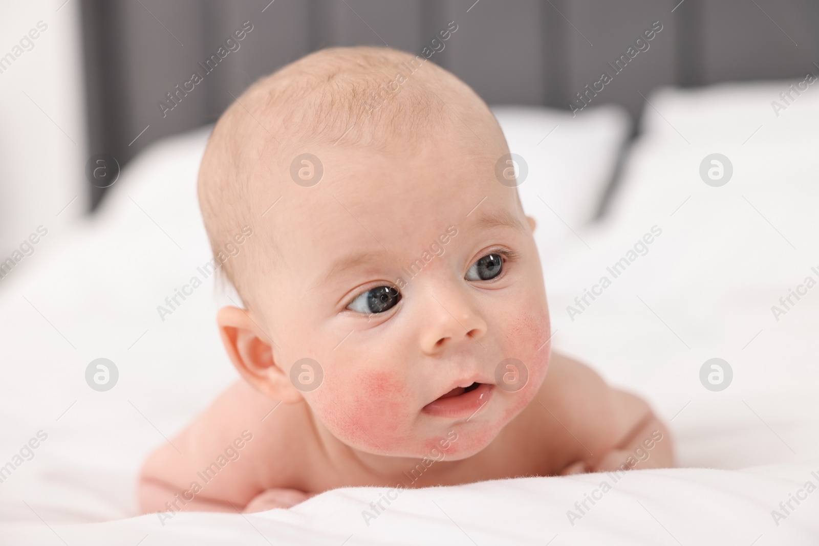 Photo of Cute little baby with allergic redness on cheeks lying on bed at home