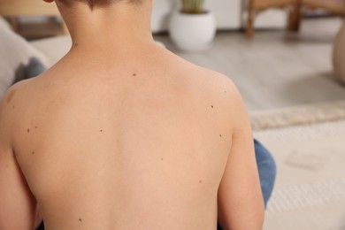 Photo of Closeup of boy's body with birthmarks in living room, back view. Space for text