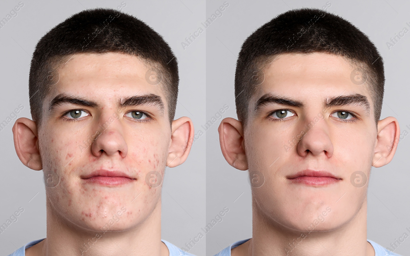 Image of Acne problem. Young man before and after treatment on grey background, collage of photos