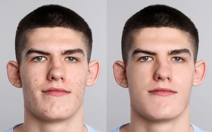 Acne problem. Young man before and after treatment on grey background, collage of photos