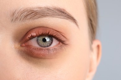 Woman suffering from conjunctivitis on light grey background, closeup of inflamed eye