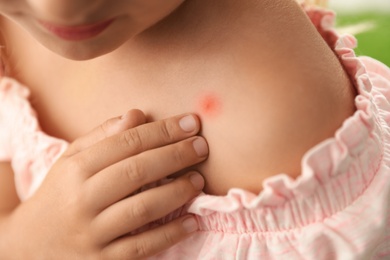 Photo of Girl scratching shoulder with insect bite, closeup