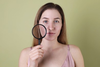 Young woman with acne problem holding magnifying glass near her skin on olive background