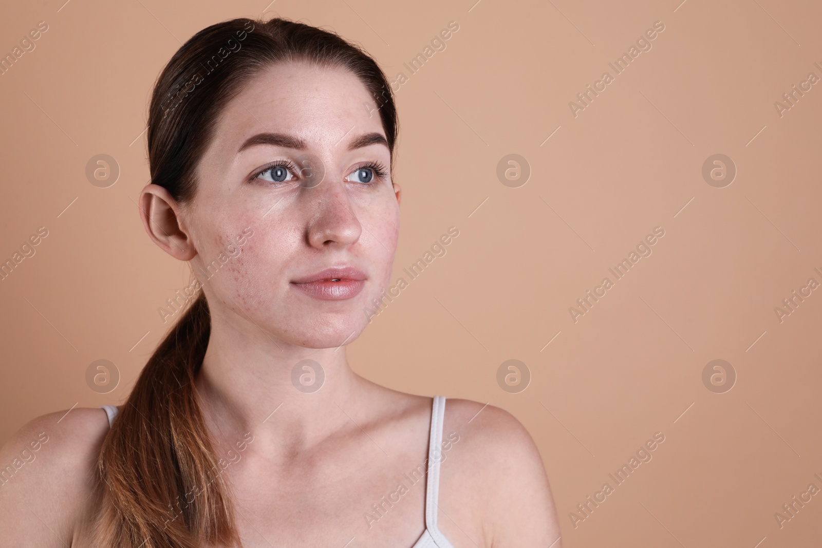 Photo of Young woman with acne problem on beige background. Space for text