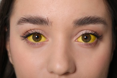 Woman with yellow eyes, closeup. Symptom of hepatitis